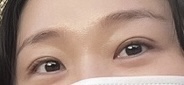  쌍커풀 수술 한달 리얼 후기(재수술/절개)