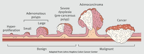 저도 이형성 선종(tubular adenoma low grade dysplasia)이란?