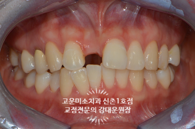  신촌교정치과 고운미소신촌1호점 증례 돌출입 앞니결손 호두주름
