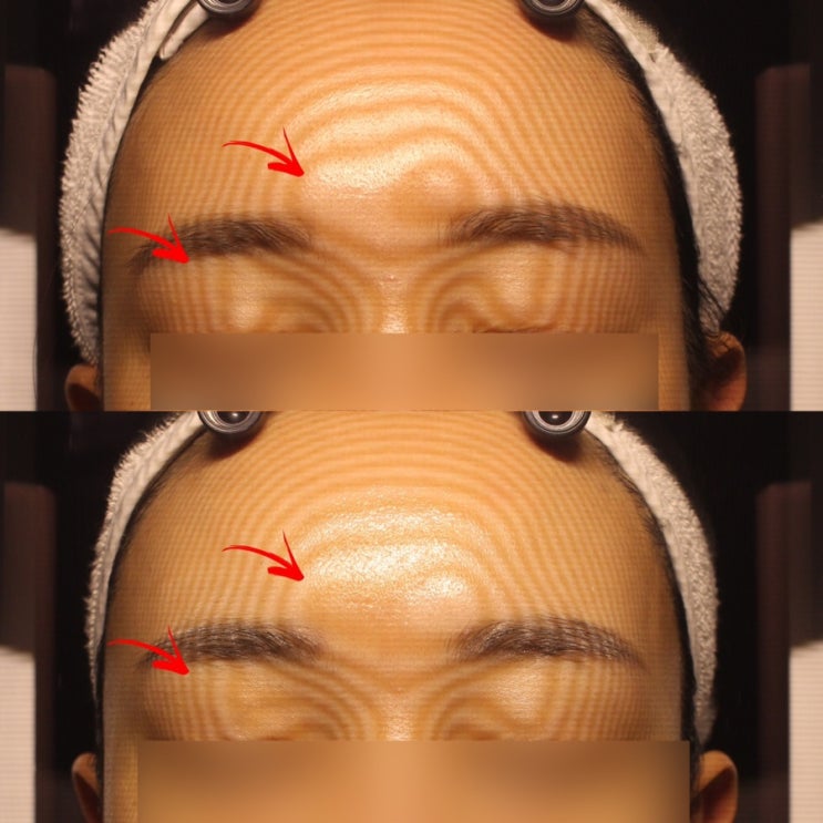  광주피부관리 에스테틱고우다 물방울테라피 수분충전 완료