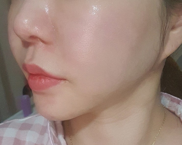  로그성형외과 리쥬란 당일~ 3주차 후기