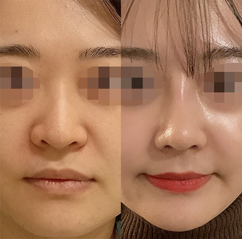  용코수술 비공내리기를 통해 교정!(강남성형외과유명한곳)