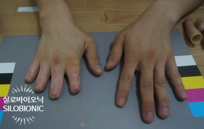  미관형 손가락 의수의 으뜸! 실로바이오닉