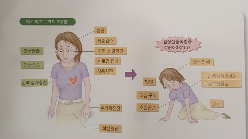 "눈이 튀어나오고, 손이 떨리고, 체중이 감소합니다" - 불광역 한의원에서 알려드리는 갑상선기능항진증의 한방치료 hyperthyriodism