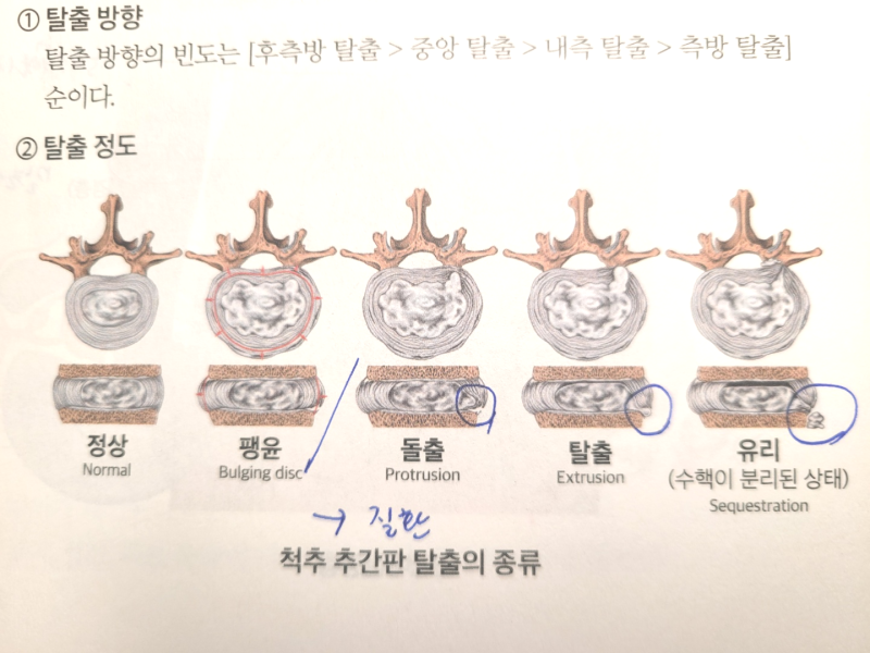 교통사고 추간판탈출증 합의방법 : 네이버 블로그