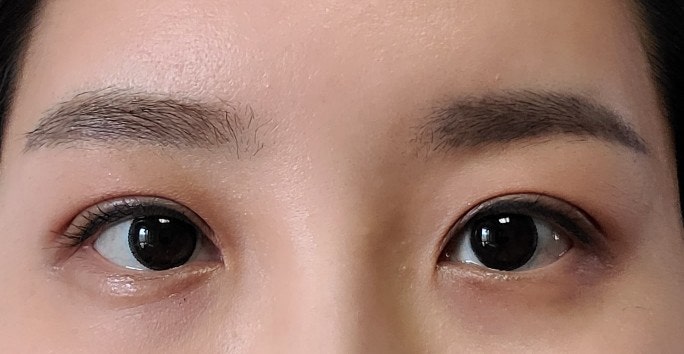  윗트임+라인변경 비절개 쌍수 후기(인라인에서 세미아웃라인으로)