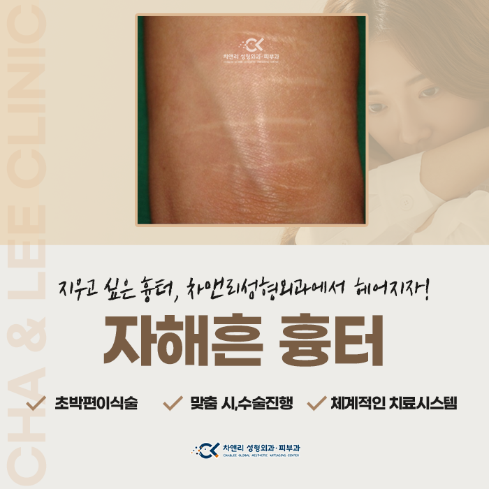  자해흔 흉터 수술전후 치료과정