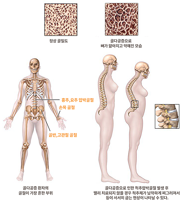 허리가 휜 경우 수술을 피하기 위해 빠른 치료가 필요합니다! 8