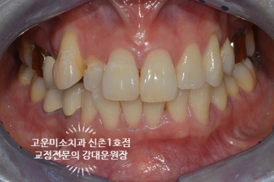  덧니 토끼이 어금니 결손 윗입술돌출 40대 교정치료 치아교정전문 고운미소신촌1호점 증례