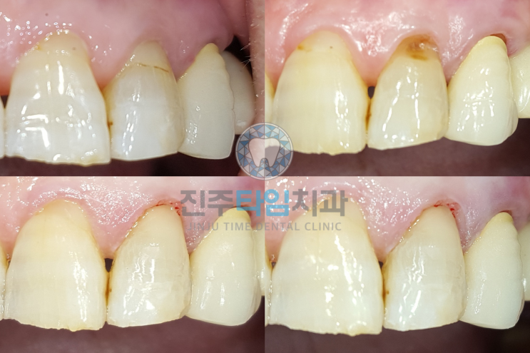  기존 충전물 탈락 #치경부레진