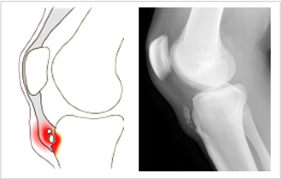  정강뼈 거친면 뼈연골증 (오스굿슐라터병, osgood-schlatter, tibial apophysitis)