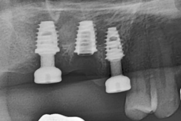  PFM 보험임플란트 #SLOCK IMPLANT