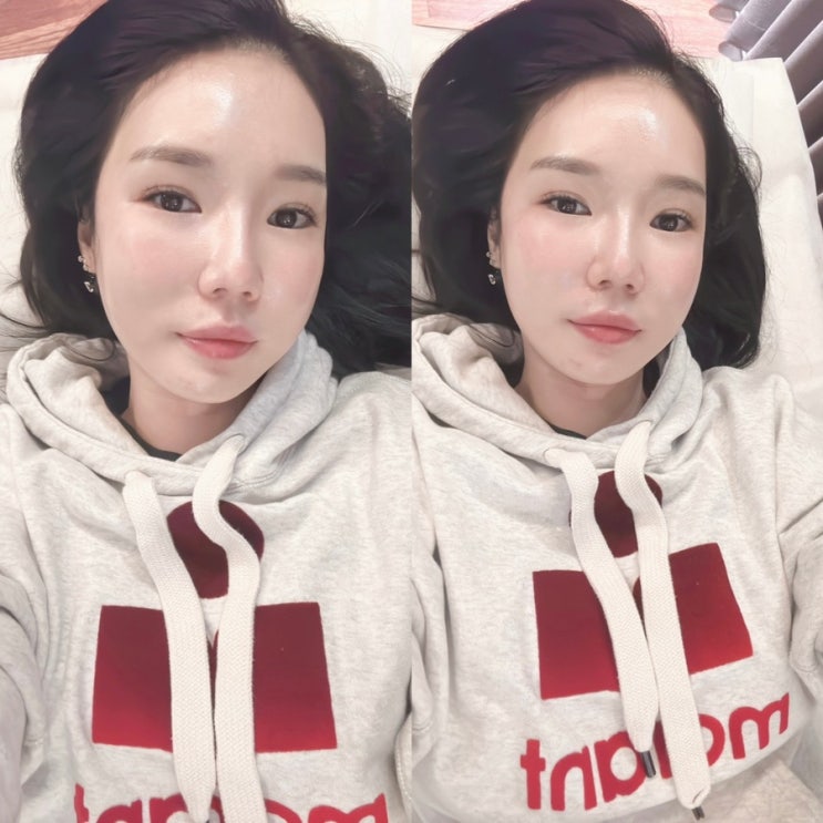  코모공레이저 청담 피부과 모공클리닉 포텐자 1회차 후기