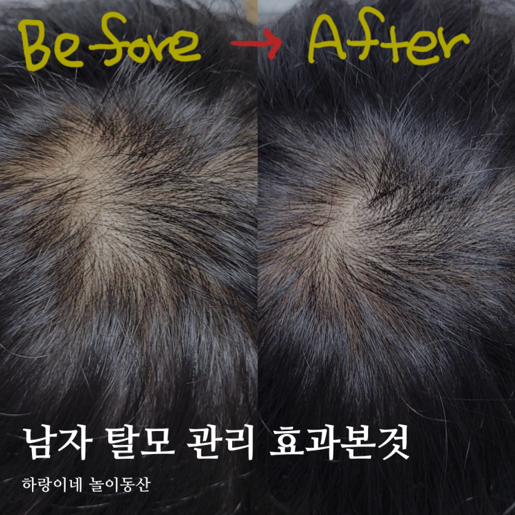  30대 남자 탈모 관리 피치두 가루 샴푸 두피팩