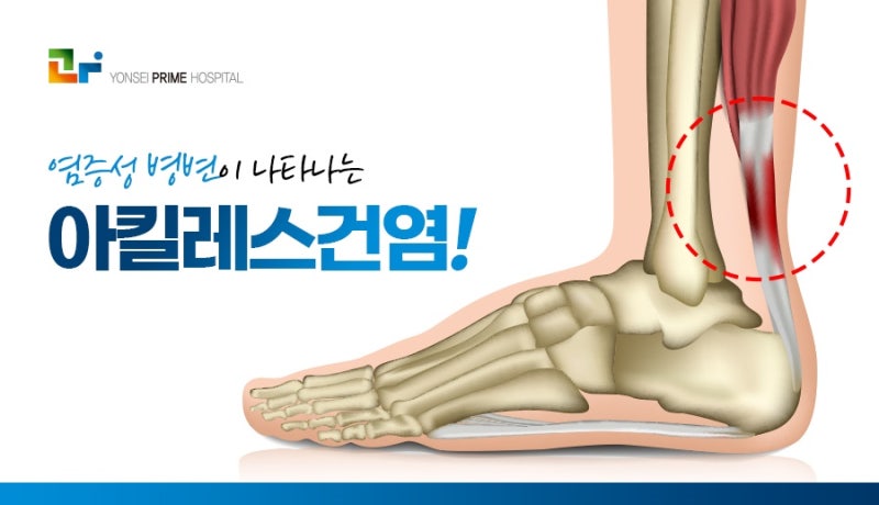 아킬레스건 파열 부상 4