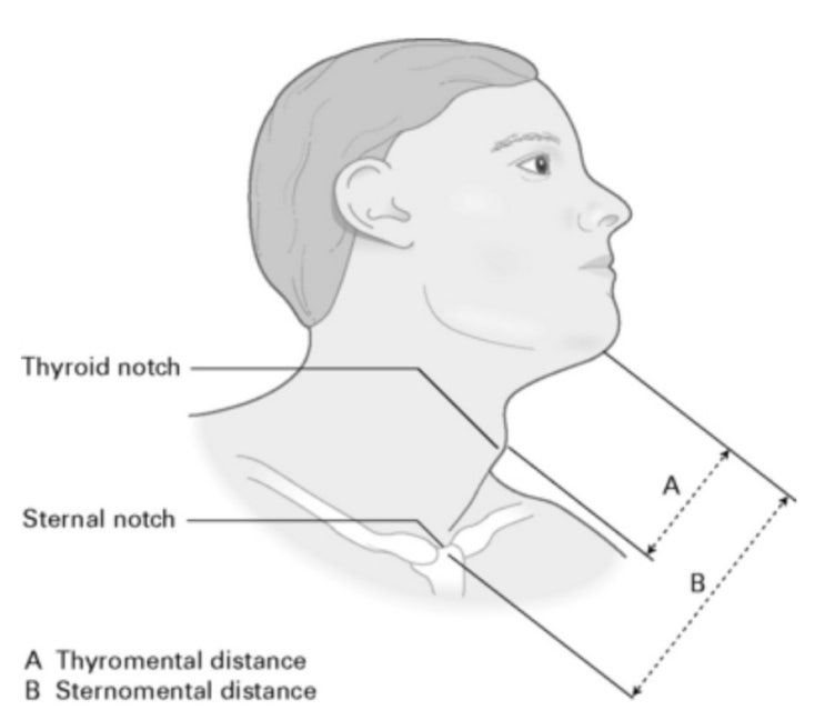  sternomental distance 와 atlantooccipital extension에 관하여.(기도 평가-3)