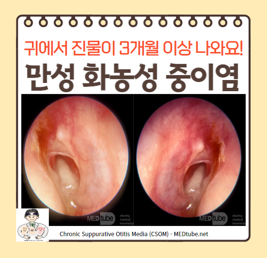  만성 중이염(chronic otitis media, COM) (1) - 만성 화농성 중이염(chronic suppurative otitis media, CSOM)