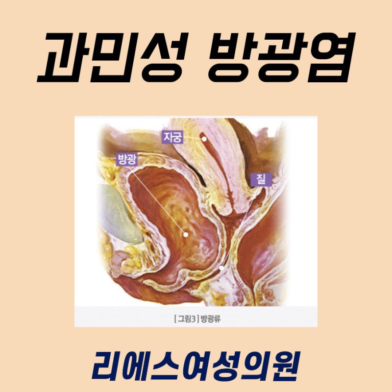과민성 방광염 치료 산부인과 vs 비뇨기과 어디가 좋을까