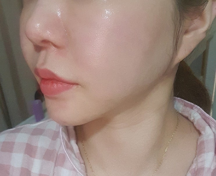  청담동피부과 통증없는 티타늄리프팅 당일~2주후기