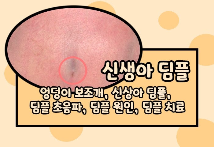  | 신생아 딤플 | 선생님!! 우리 애 엉덩이 사이가 파여있는데요!!!