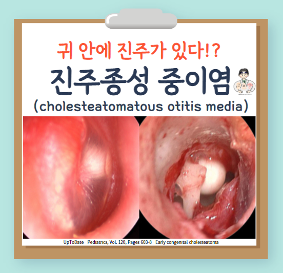  만성 중이염(chronic otitis media, COM) (2) - 진주종성 중이염(cholesteatomatous otitis media) : 정의, 분류, 임상증상