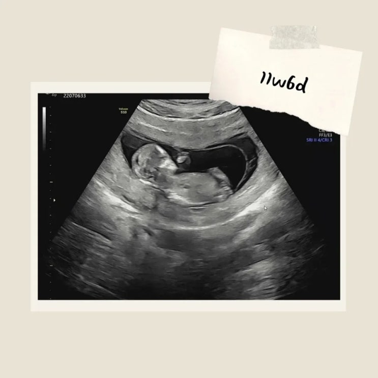 [임신 11주 6일] 두근두근 기형아검사 1차 
