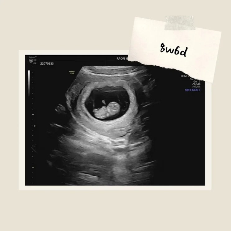 [임신 8주-9주] 일상 & 입덧 증상