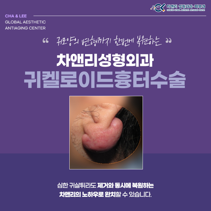  귀켈로이드 흉터수술로 피어싱이후 생긴 흉터제거해요.