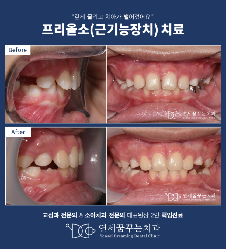어린이 과개교합(앞니가 깊게 물리는 현상) 수정이 중요한 이유(feat. 근기능장치, 프리올소) 어린이 과개교합(앞니가 깊게 물리는 현상) 수정이 중요한 이유(feat. 근기능장치, 프리올소)