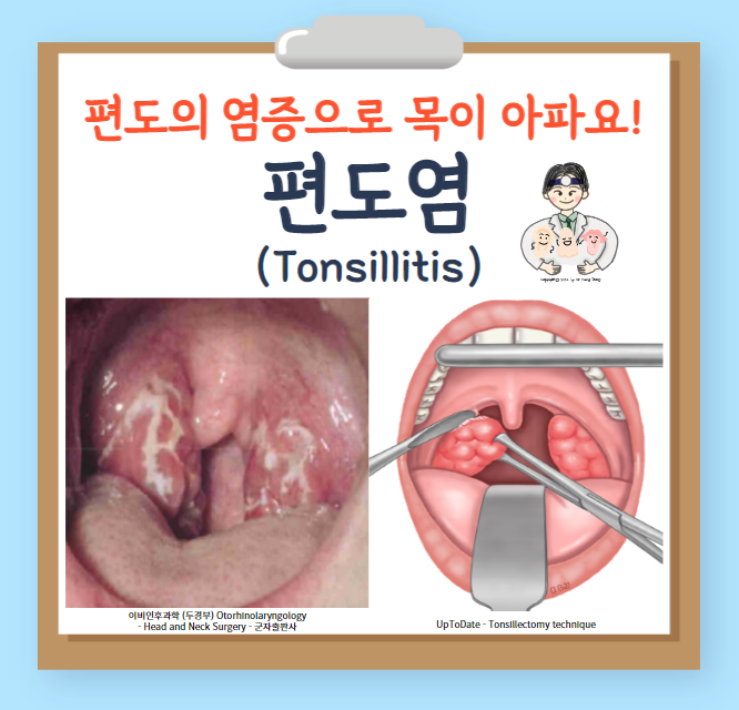  편도염(tonsillitis) - 급성 편도염, 재발성 급성 편도염, 만성 편도염
