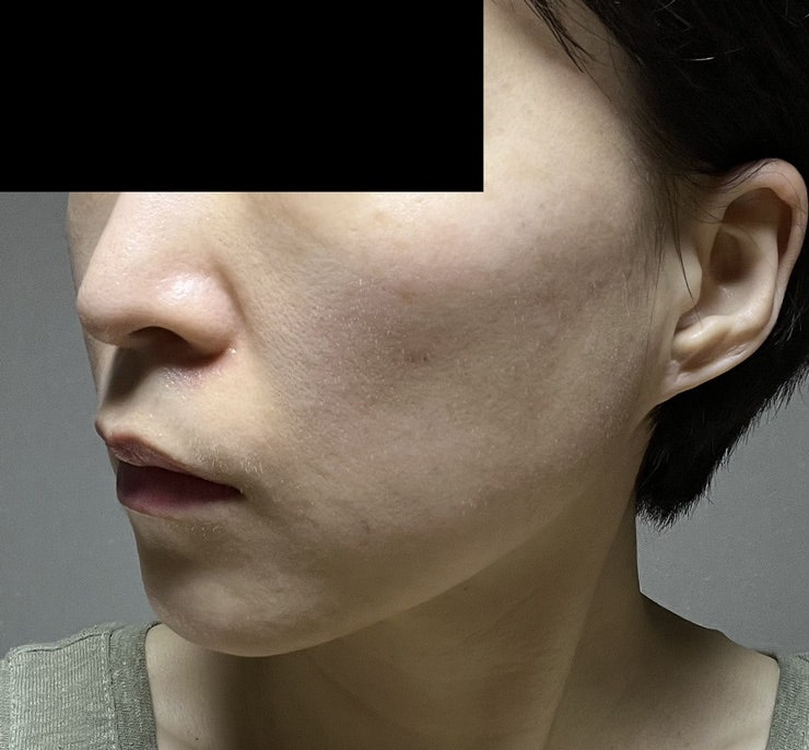 (분리불가피부+얼굴라인) 레이저성형, V자리프팅