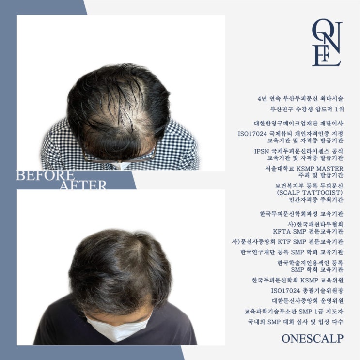  온천장 두피문신, SMP진짜 커버가 될까?