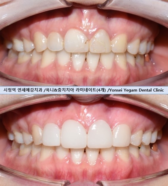  [Yonsei Yegam Dental Clinic,Seoul/event] Veneer indication, event cost, before&after photos