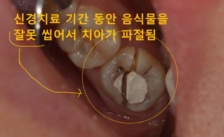강일동치과 신경치료 기간 동안 신경치료하는 치아 쪽으로 씹지 말라는 이유