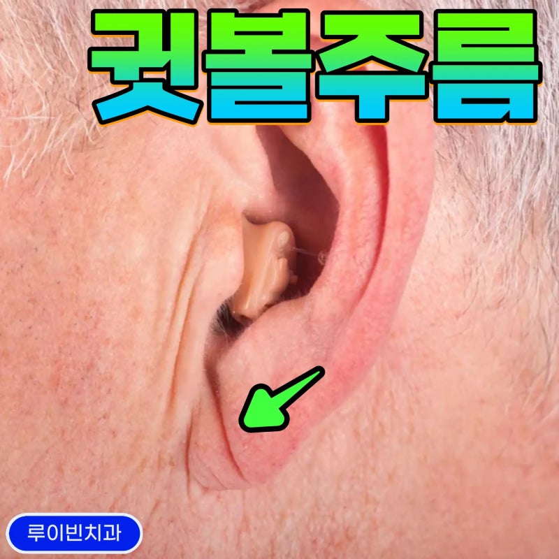 귓불 주름(귀 주름), 말문이 막히는 것은 심혈관 및 뇌혈관 질환의 위험 신호