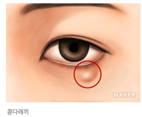 다래끼란 무엇인가? A to Z 다래끼란 무엇인가? A to Z