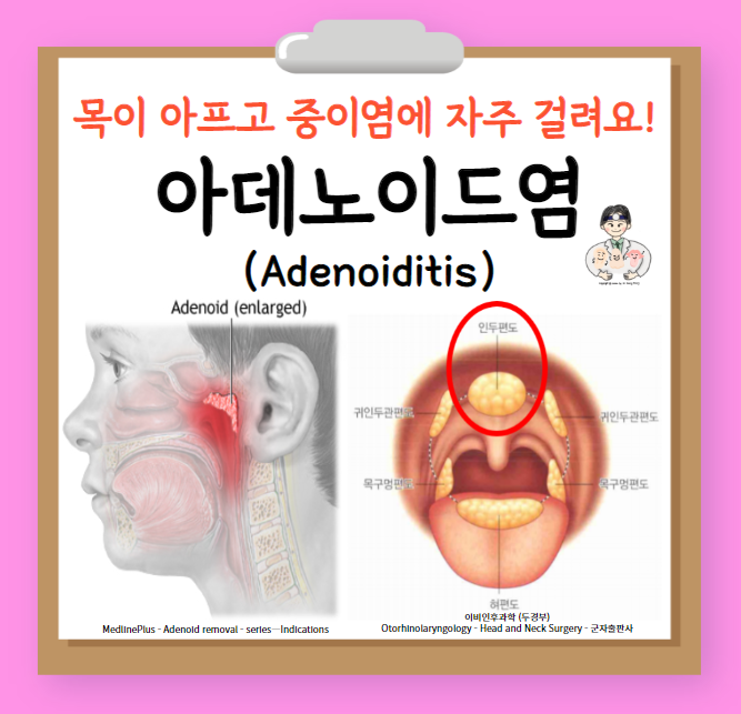  아데노이드염(adenoiditis) - 급성 아데노이드염, 재발성 급성 아데노이드염, 만성 아데노이드염