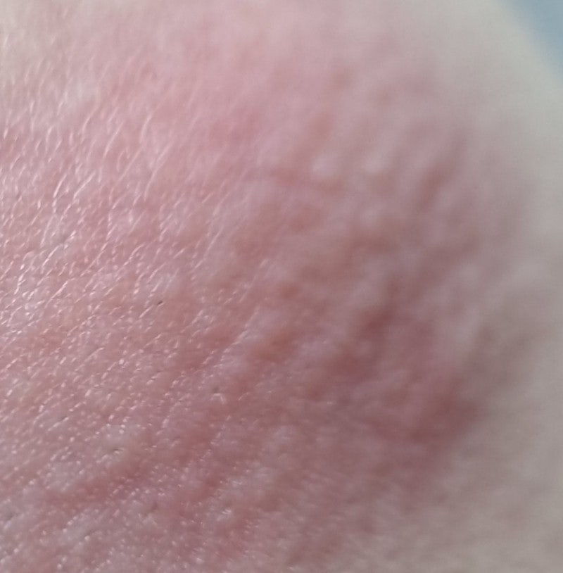 피지낭종 종기 극소마취 제거수술 회복기 (수술비용 수술과정 수술흉터) : 네이버 블로그