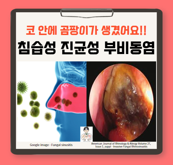 진균성 부비동염(fungal sinusitis) (1) - 침습성(invasive) 진균성 부비동염 : 급성 전격성 / 만성 침습성 / 만성 육아종성 침습성