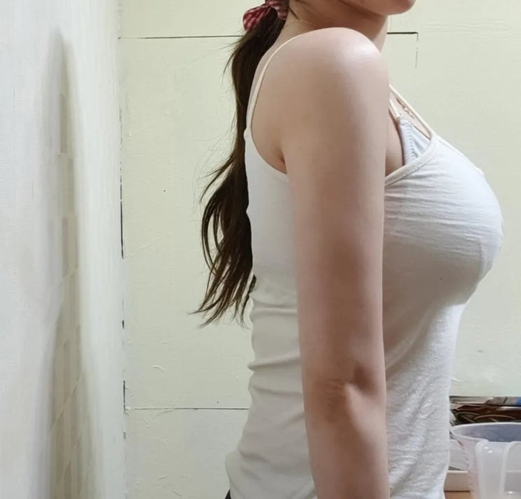  선릉역피부과 팔뚝지방분해주사 지방쏙 2회차후기