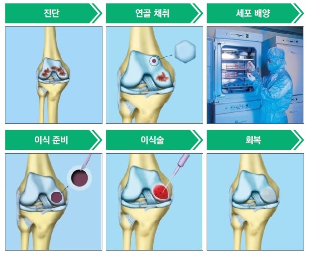 관절연골 재생의 역사와 전개 : 네이버 블로그