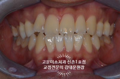  돌출 송곳니결손 2급부정교합 신촌치과 신촌치아교정전문 고운미소 신촌1호점치료증례