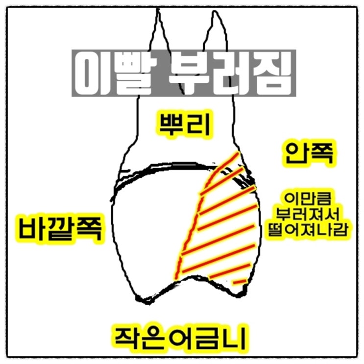 이빨 부러졌다 작은어금니 부러짐 치과 다녀온 후기