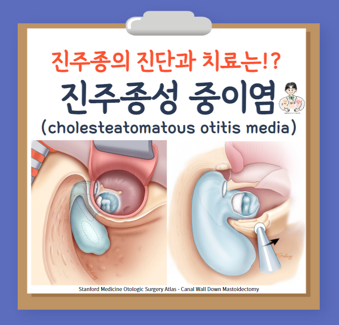  만성 중이염(chronic otitis media, COM) (3) - 진주종성 중이염(cholesteatomatous otitis media) : 진단, 치료