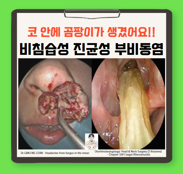  진균성 부비동염(fungal sinusitis) (2) - 비침습성(non-invasive) 진균성 부비동염 : 진균구 / 알레르기성