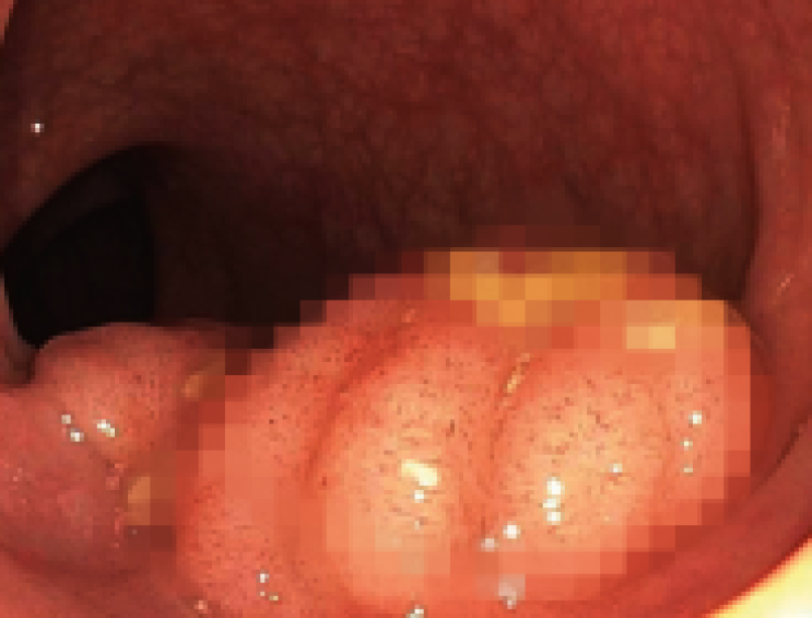 노원 대장내시경? 실패하는 분들의 1가지 공통점