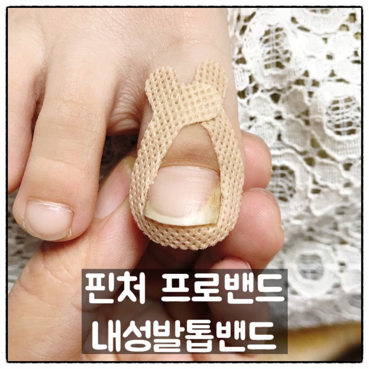  핀처 프로밴드 내성발톱테이프 내성발톱 자가치료 아이템 사용후기