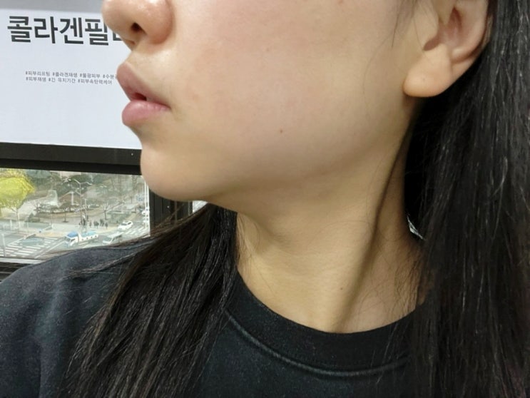 연말맞이 얼굴윤곽관리! 강남피부과에서 브이핏톡스 하고 온 후기! 연말맞이 얼굴윤곽관리! 강남피부과에서 브이핏톡스 하고 온 후기!