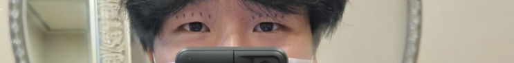  남자 부분절개 쌍수 후기 1~3일차 (광고X, 내돈내쌍, 속쌍, 눈매교정)