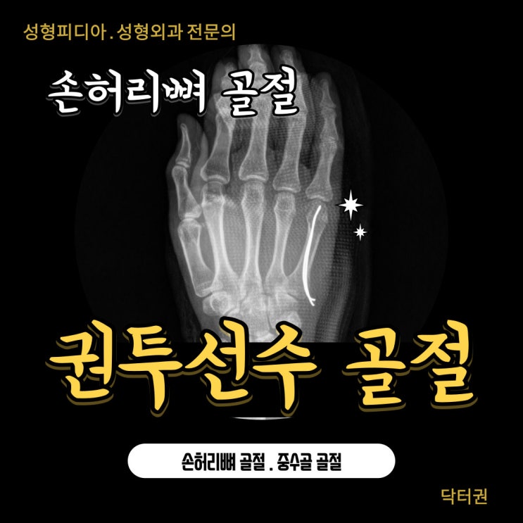 [수부] 손허리뼈 골절 (중수골 골절, 권투선수 골절, Boxer's fracture)